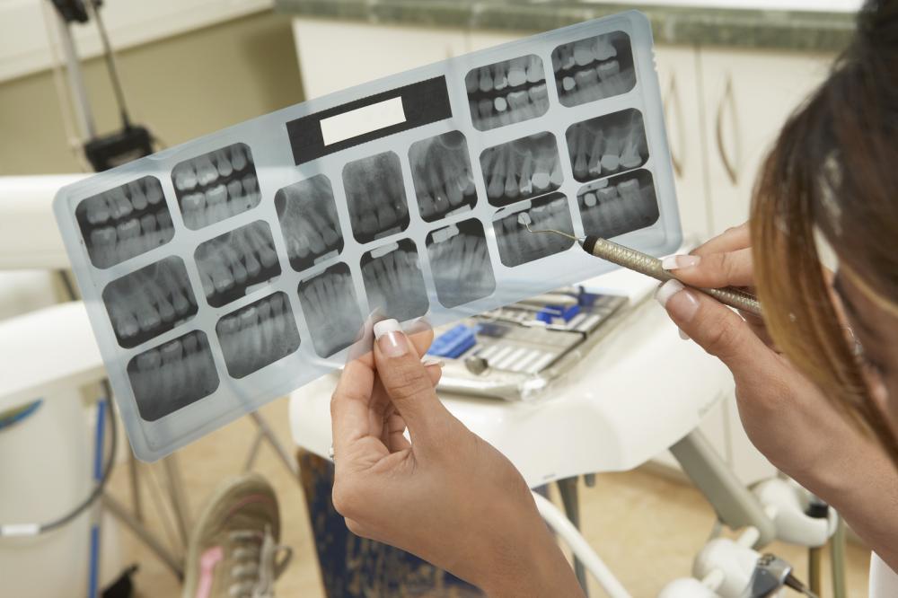 dental implants